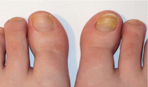 kojų nagų grybelio simptomai