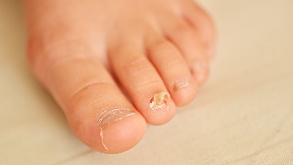kojų nagų grybelio simptomai