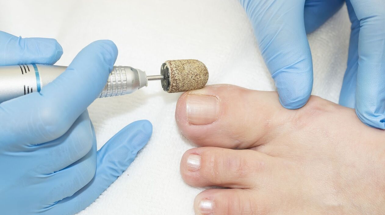 aparatinis grybelio ant kojų nagų gydymas