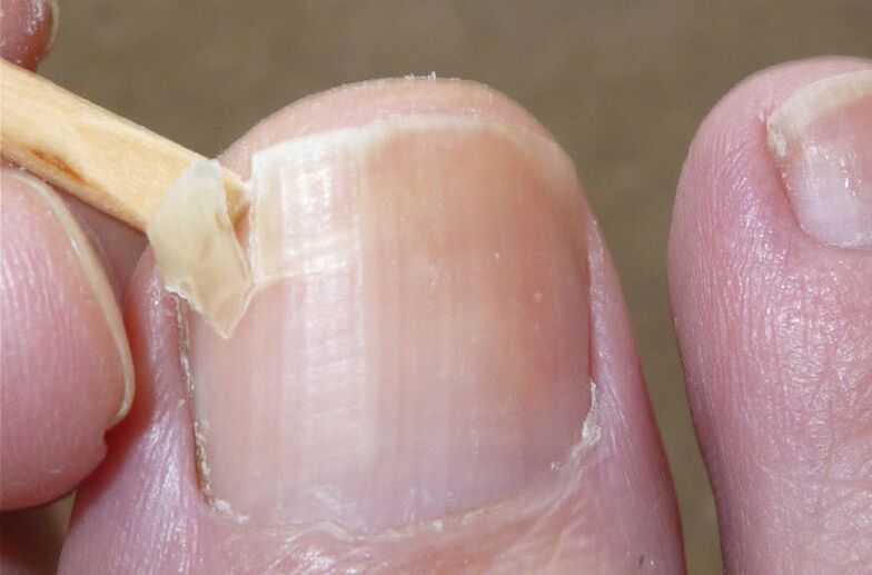 Pažeisti nagai yra grybelinės infekcijos rizikos veiksnys