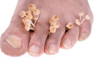 Kojų nagų onichomikozė