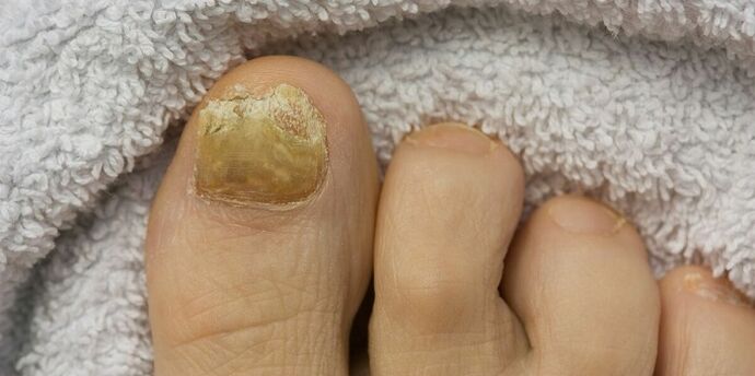 geltonas kojų nagas su grybeline infekcija
