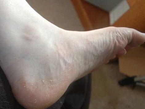 kojos pėdos lupimasis kaip grybelinės infekcijos požymis